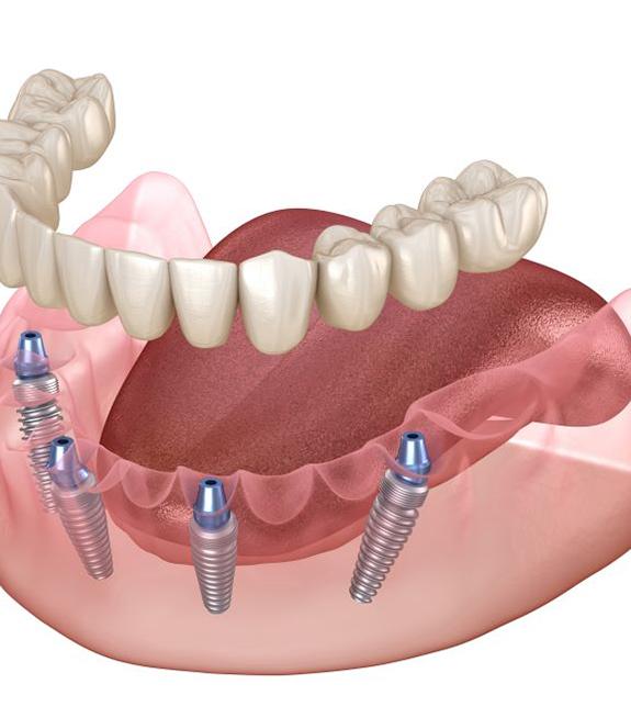 Illustration of All on 4 dental implants in Corpus Christi