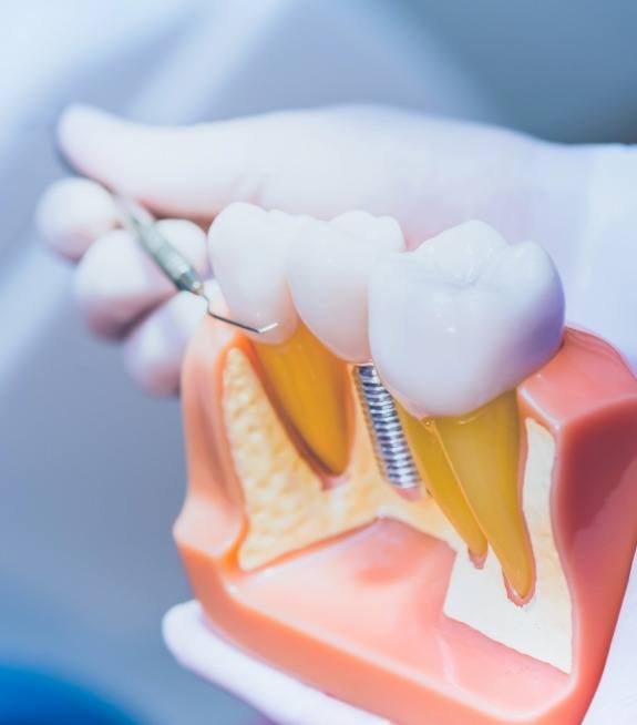 Dentist showing a patient a model of dental implants