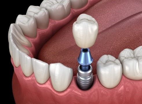 Illustrated dental crown being placed on a dental implant