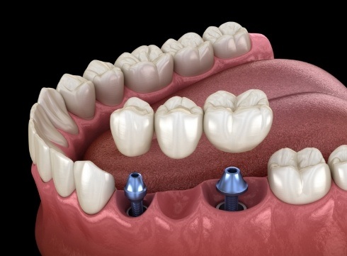 Illustrated dental bridge being placed on two dental implants