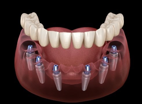 Illustrated full denture being placed on six dental implants