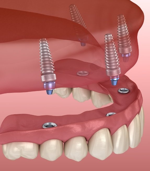 Illustrated implant denture being placed on upper arch