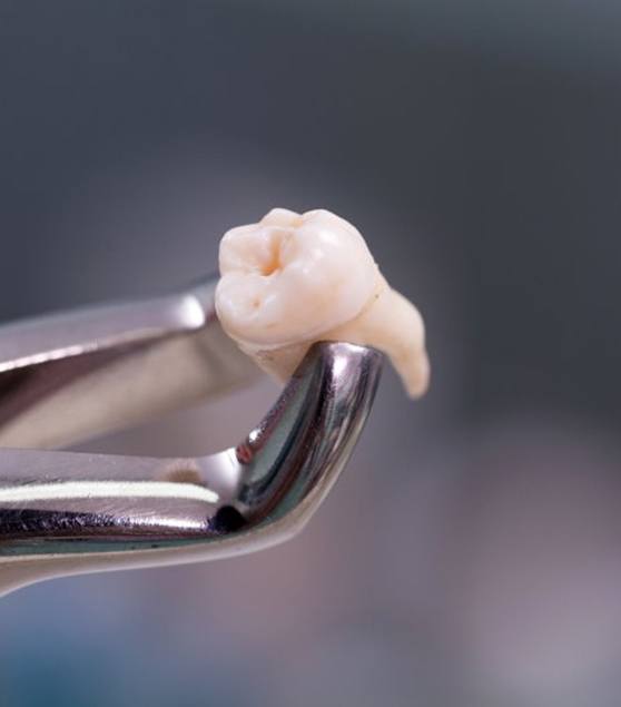 Forceps carefully holding an extracted tooth