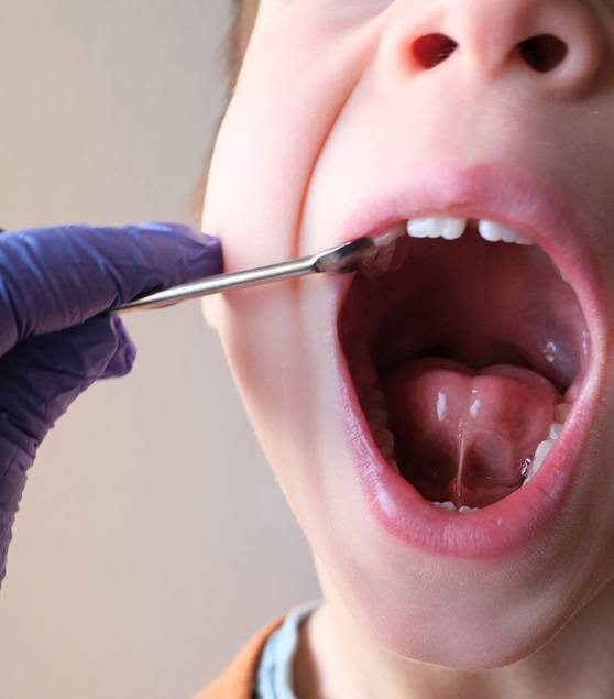 Child in Corpus Christi showing tongue-tie symptoms 