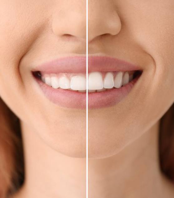 Before and after photos of a patient’s smile before/after her gingivectomy 