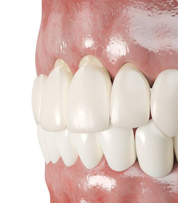 Illustration of front teeth with receding gums before gum grafting in Corpus Christi