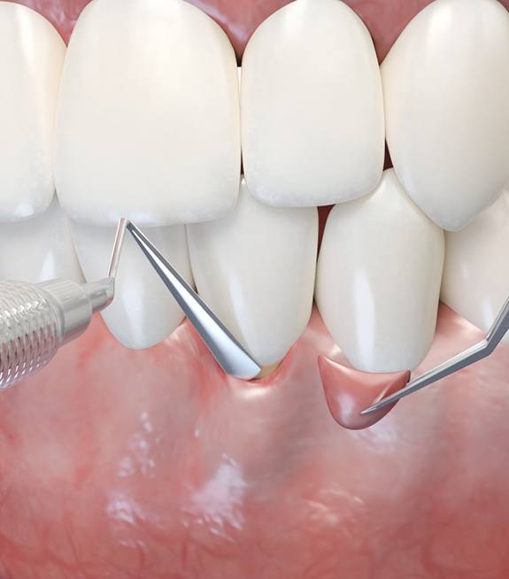 Illustration of dental instruments being used to apply gum graft