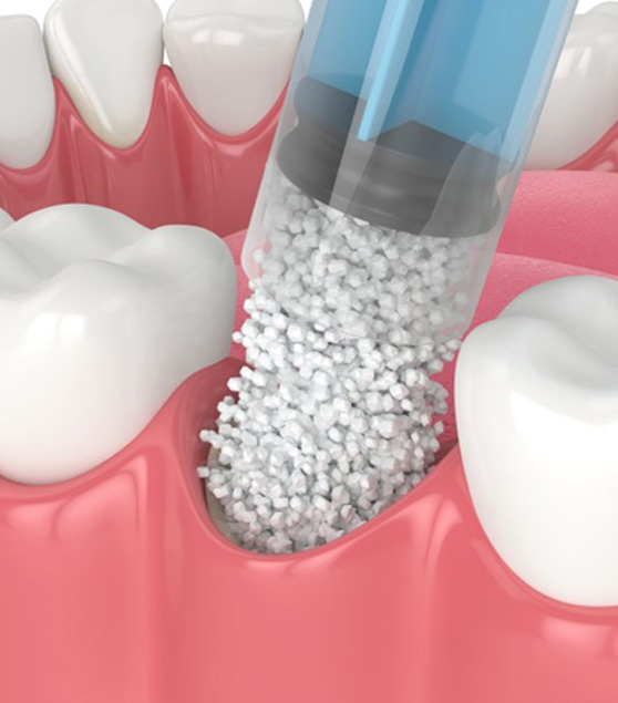 a 3D depiction of the bone grafting process