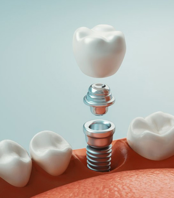 a 3D illustration of a dental implant in the jawbone