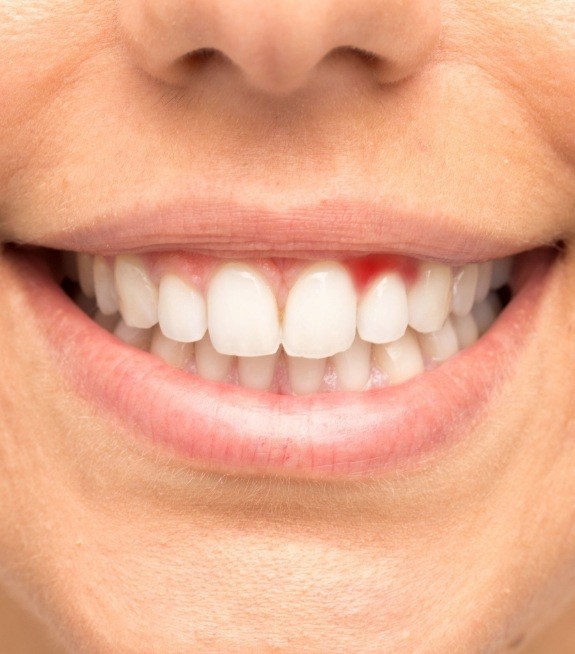 Close up of smile with damaged gums before gum disease treatment