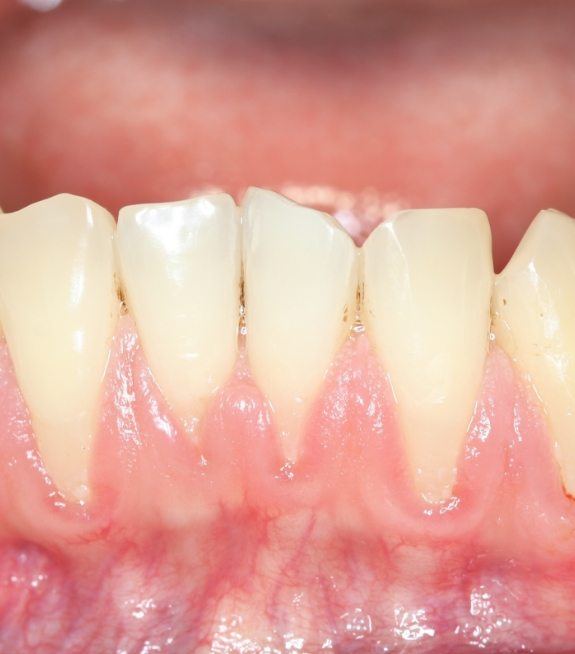 Close up of smile with receding gums