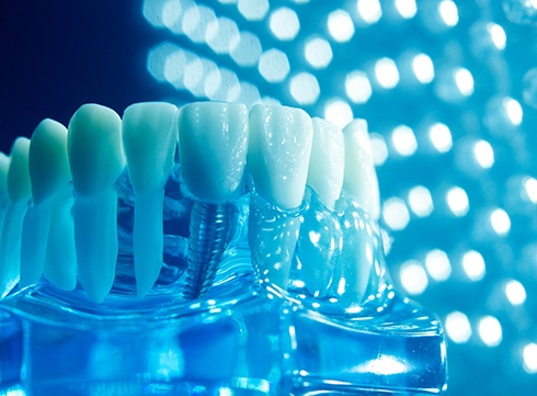 Model of the mouth with a dental implant
