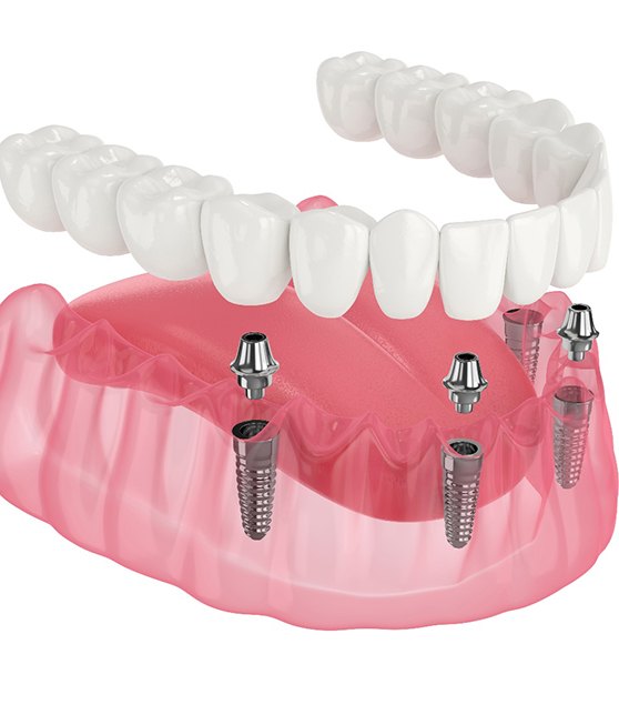 Illustration of implant dentures in Corpus Christi being placed on lower arch