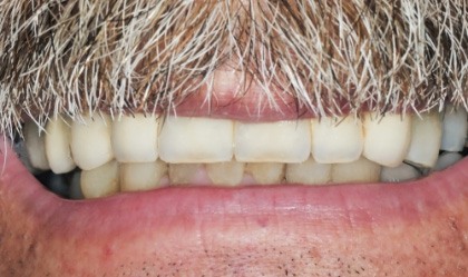 Close up of smile with a full set of flawless teeth