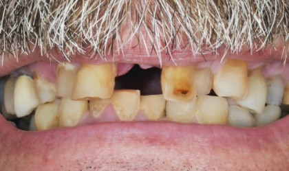 Close up of smile with damaged and missing teeth