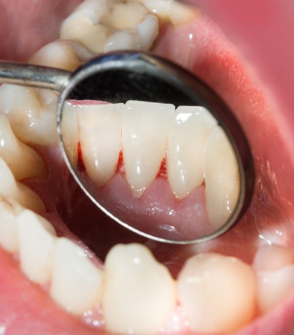 Close up of mouth during oral cancer screening