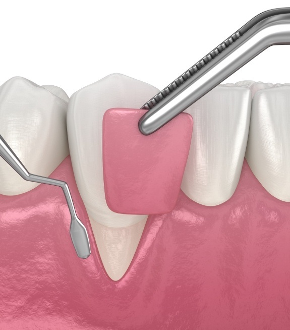 Illustrated gum tissue being grafted over a tooth during surgical periodontal treatment