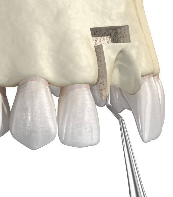 Illustration of bone grafting material being placed into the upper jawbone