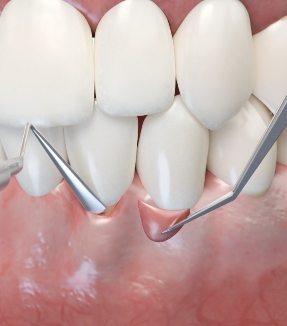 Illustration of crown lengthening procedure