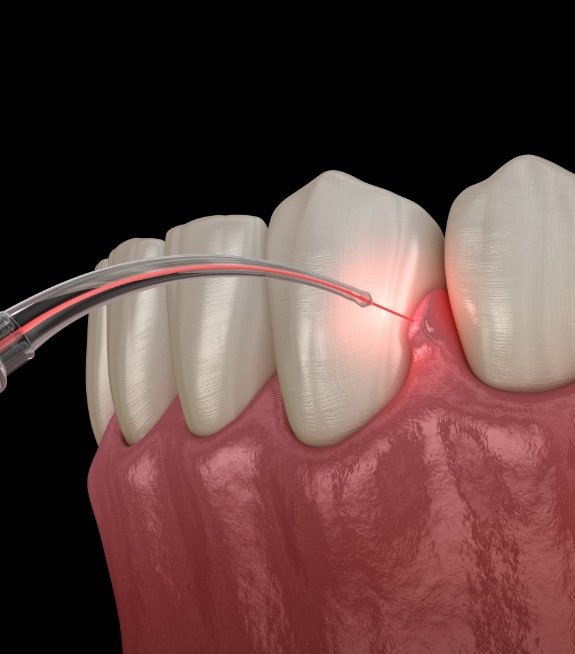 Illustrated dental laser treating the gums