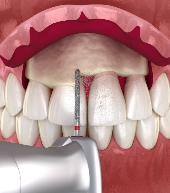 Illustration of gum tissue being reshaped