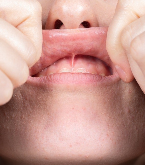 Close up of person stretching up their upper lip