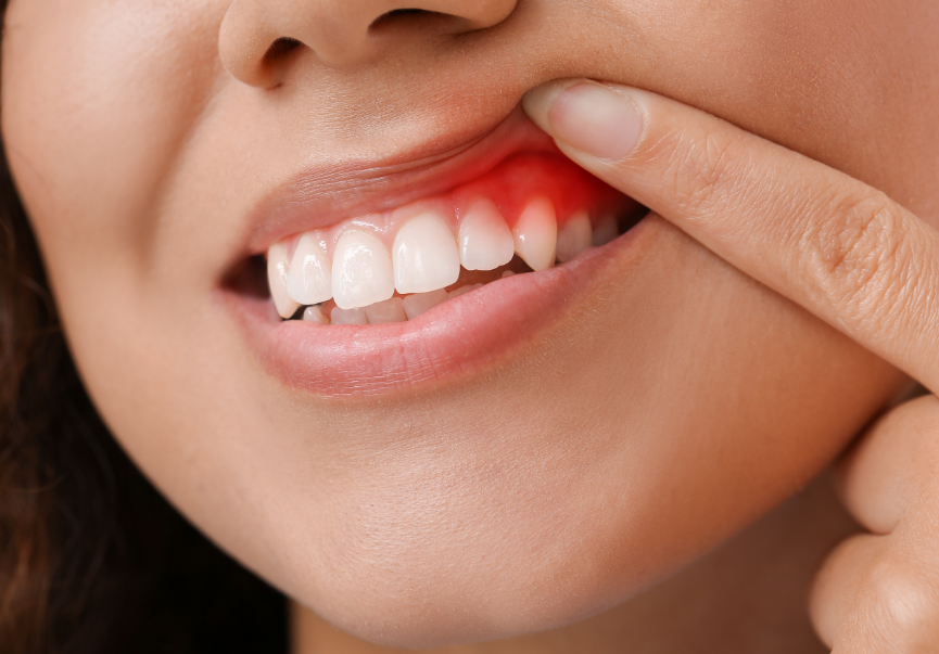 Woman with inflamed gums