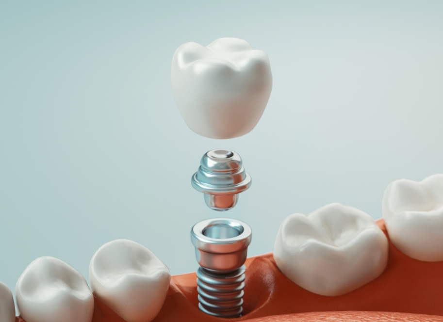 3D image of a dental implant