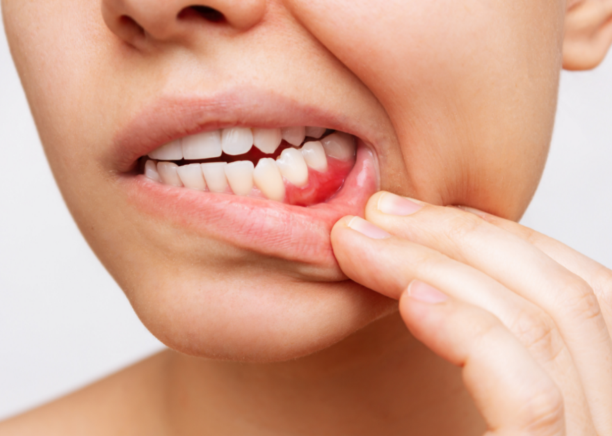 Close up of woman showing inflamed gums