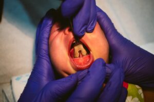 Dentist performing frenectomy on child. 