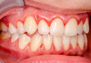 Close-up of gingivitis (red, swollen gums).